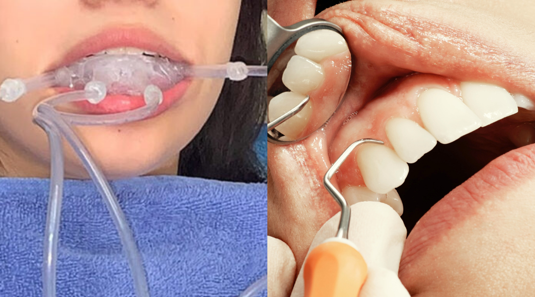 Blanqueamiento dental con Ozono